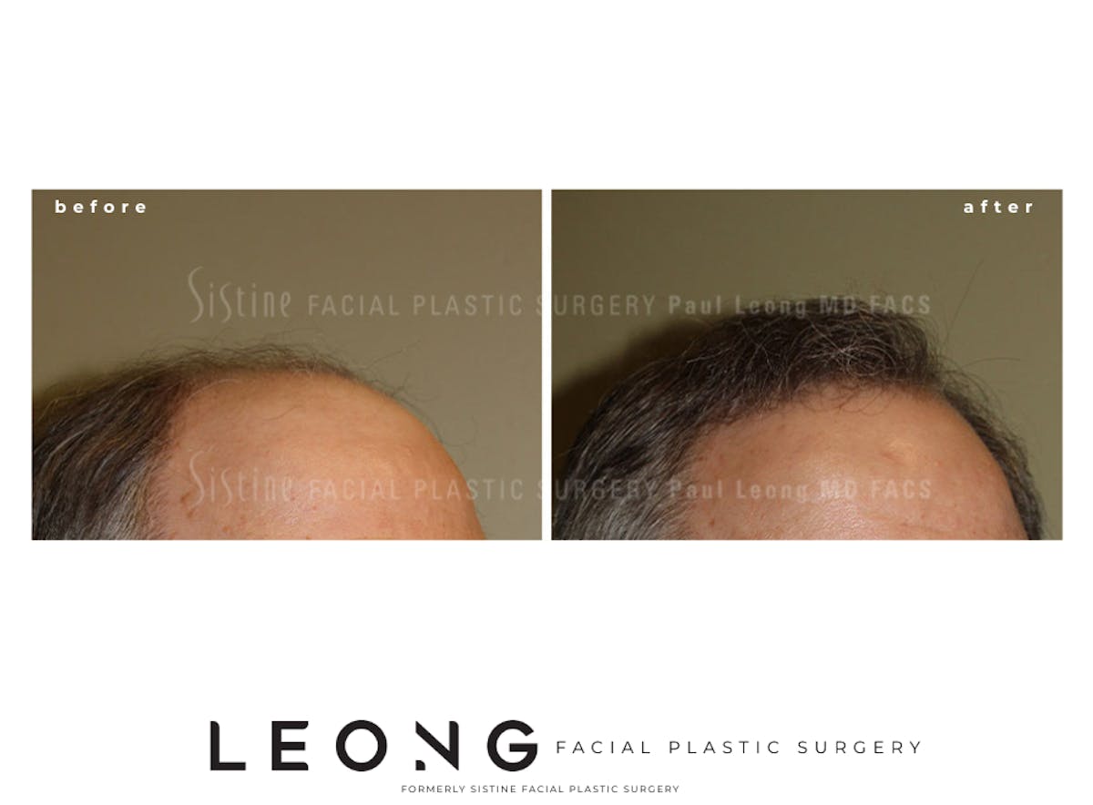 Hair Transplant Before & After Gallery - Patient 304923 - Image 2