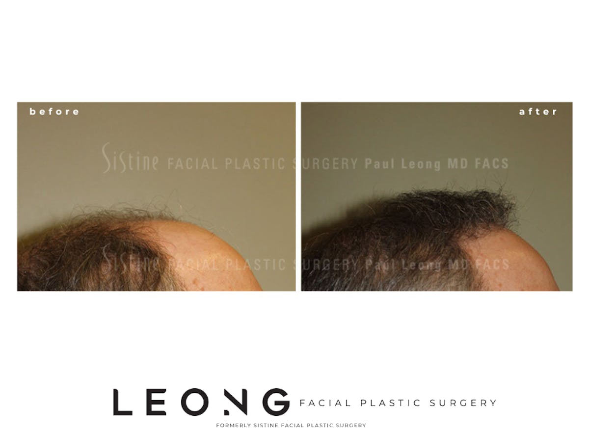 Hair Transplant Before & After Gallery - Patient 304923 - Image 3