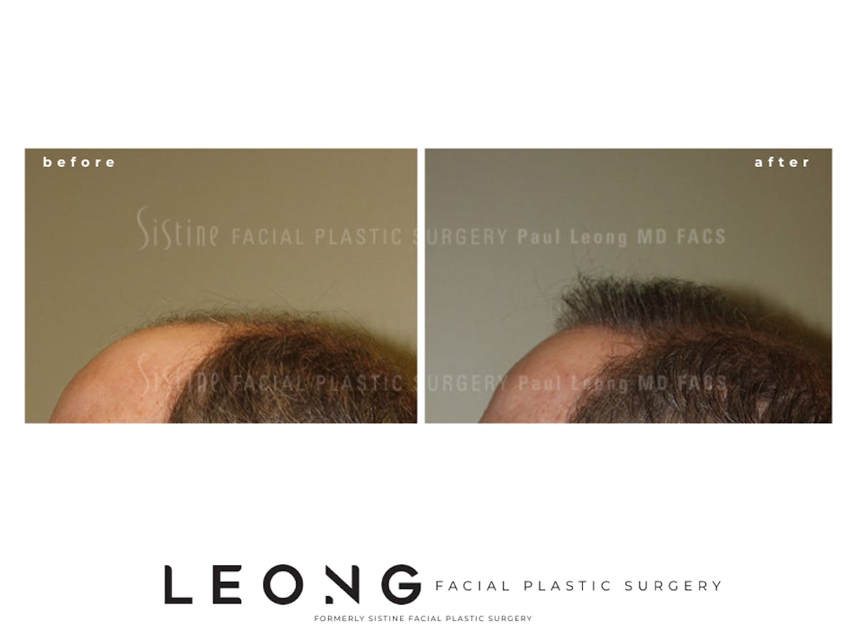 Hair Transplant Before & After Gallery - Patient 304923 - Image 4