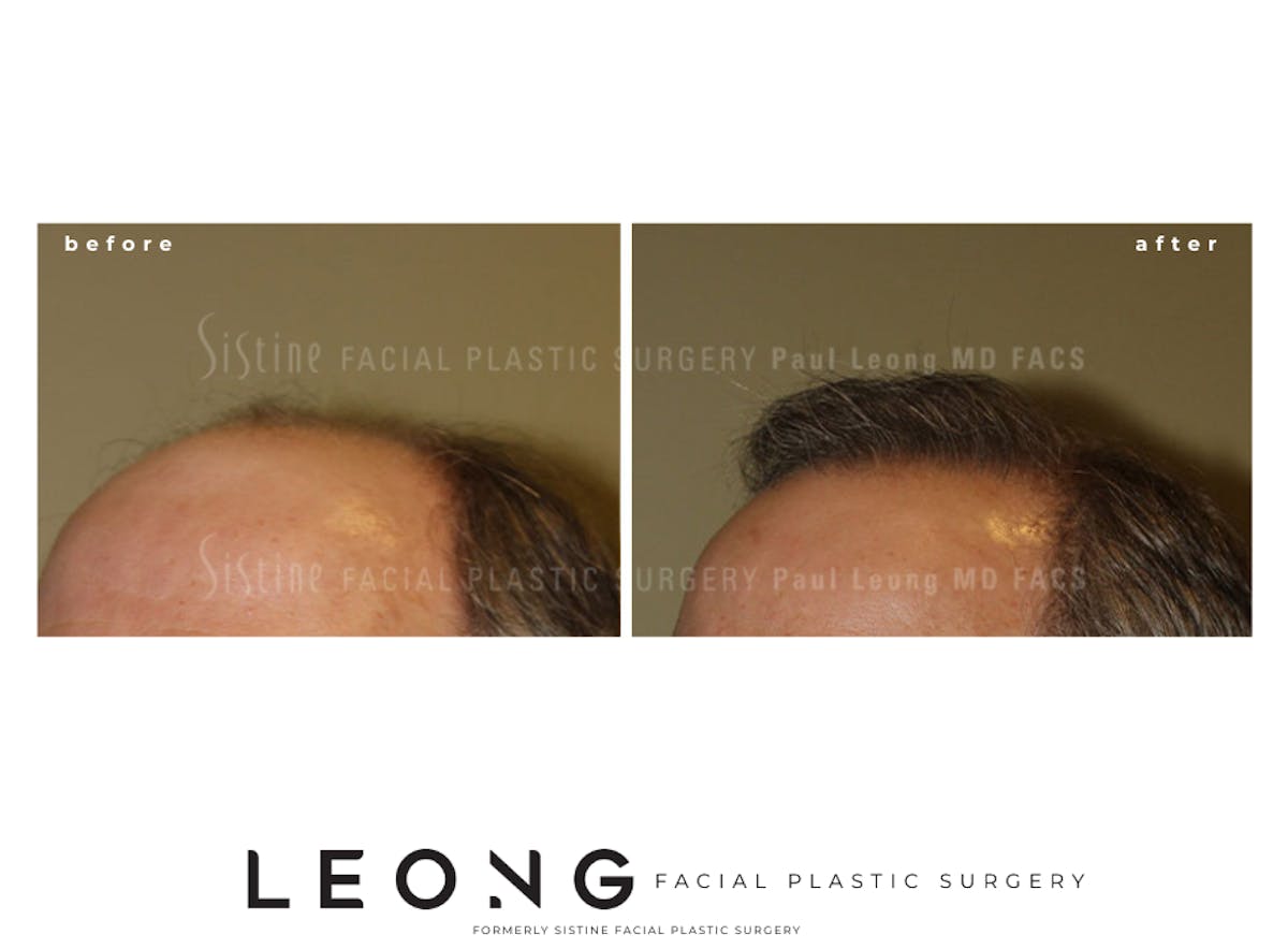 Hair Transplant Before & After Gallery - Patient 304923 - Image 5
