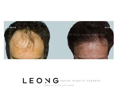 Hair Transplant Before & After Gallery - Patient 203168 - Image 1