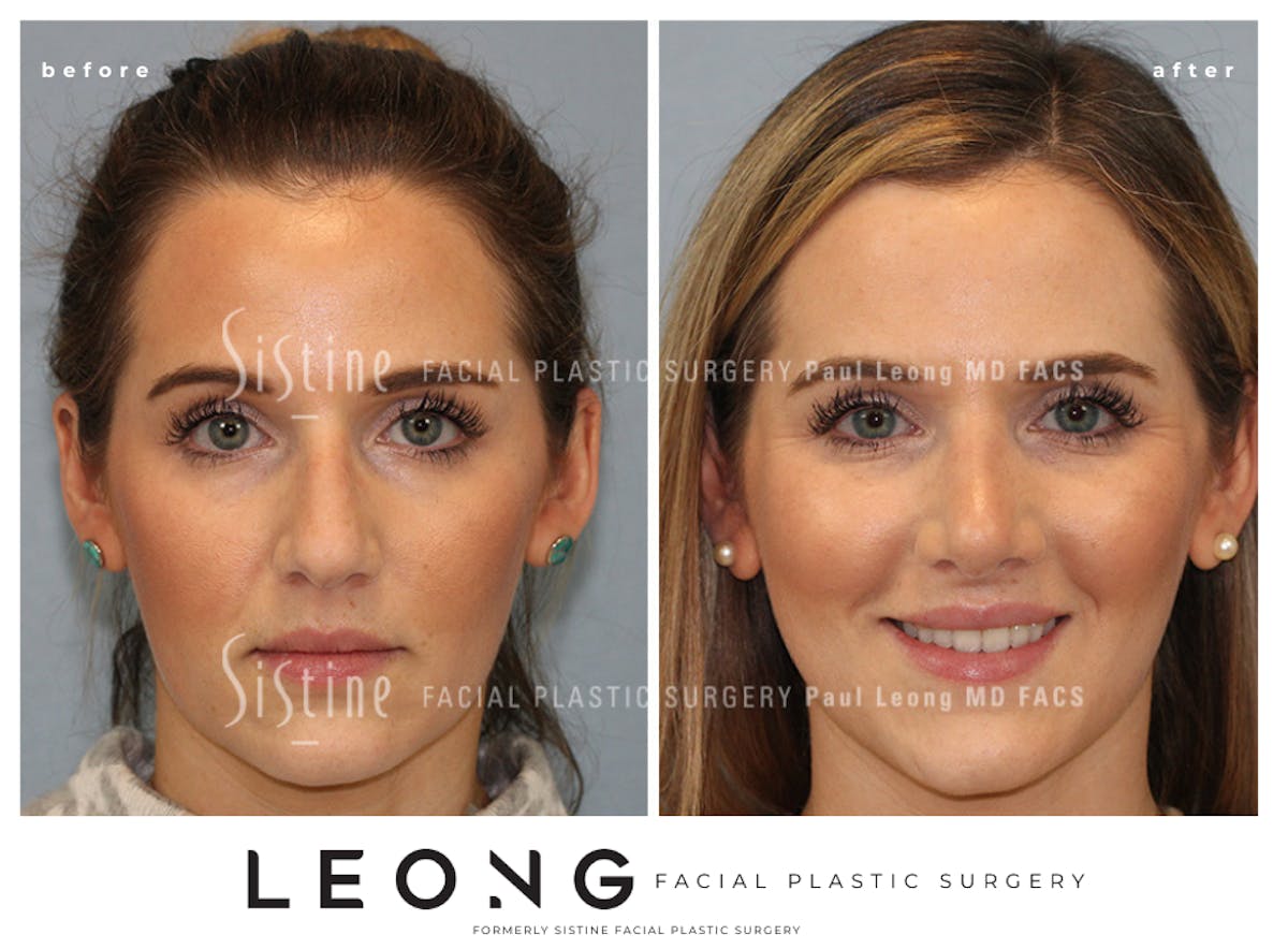 Rhinoplasty Before & After Gallery - Patient 985131 - Image 3