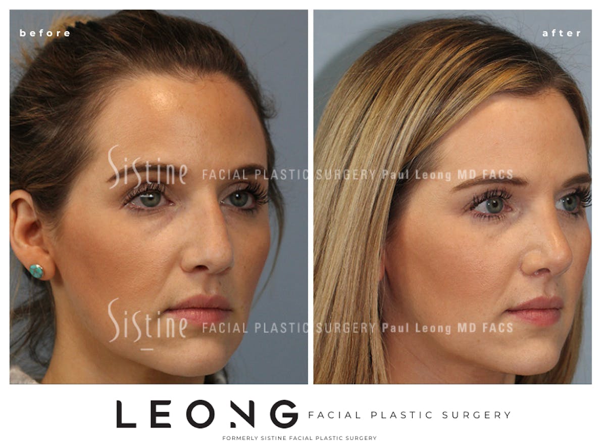 Rhinoplasty Before & After Gallery - Patient 985131 - Image 4