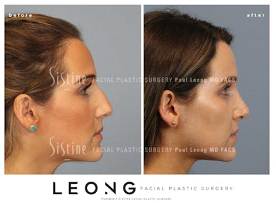 Rhinoplasty Before & After Gallery - Patient 985131 - Image 1