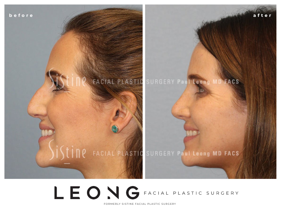 Rhinoplasty Before & After Gallery - Patient 985131 - Image 2