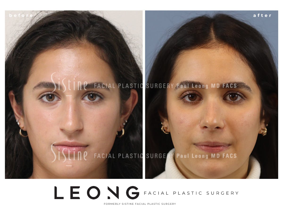 Rhinoplasty Before & After Gallery - Patient 293286 - Image 2