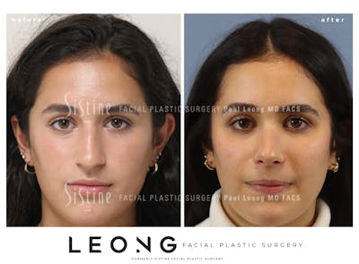 Rhinoplasty Before & After Gallery - Patient 293286 - Image 1