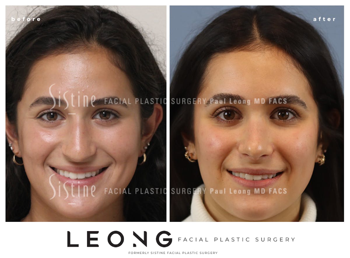 Rhinoplasty Before & After Gallery - Patient 293286 - Image 3