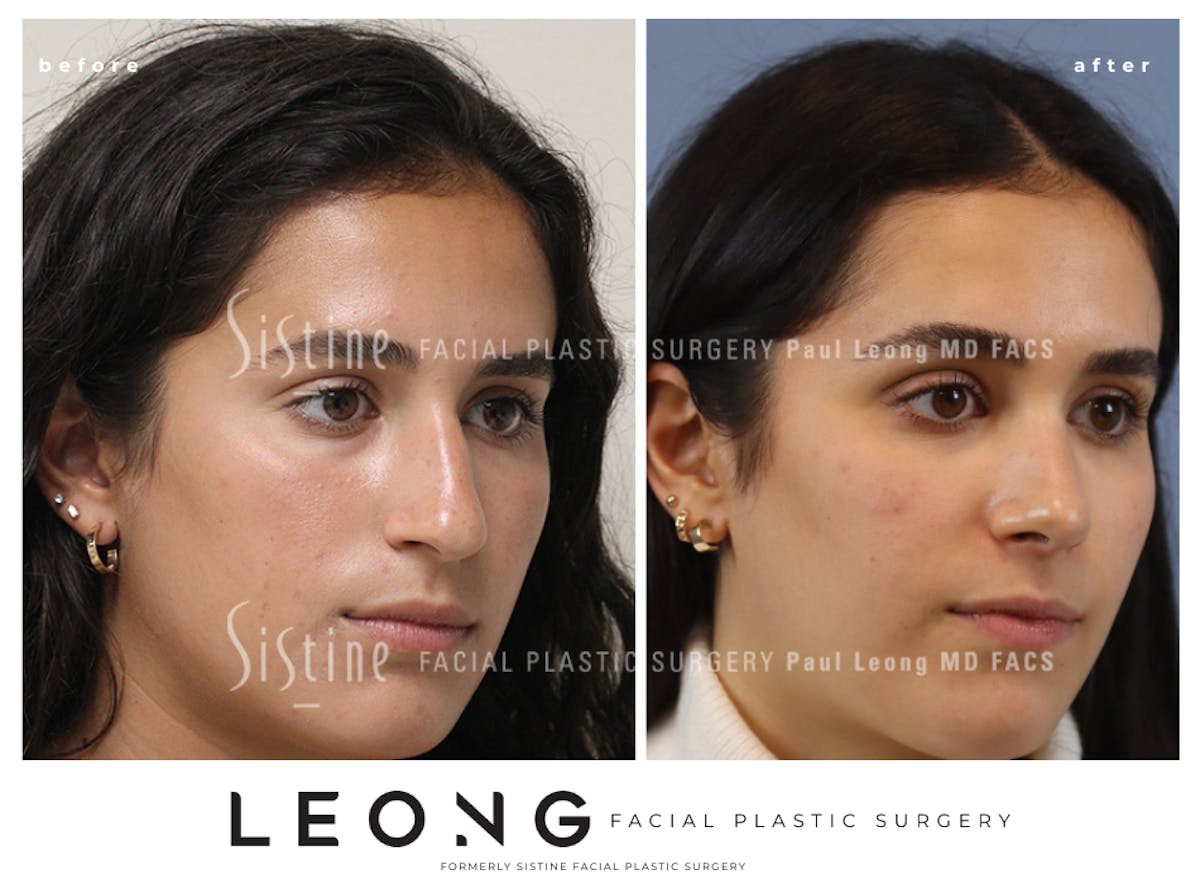 Rhinoplasty Before & After Gallery - Patient 293286 - Image 4