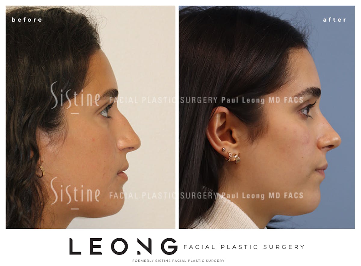 Rhinoplasty Before & After Gallery - Patient 293286 - Image 5