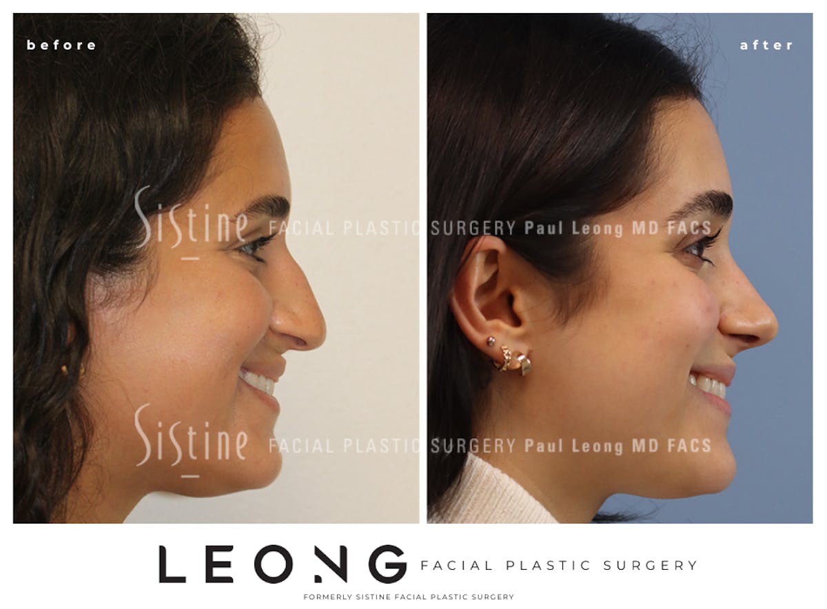Rhinoplasty Before & After Gallery - Patient 293286 - Image 1