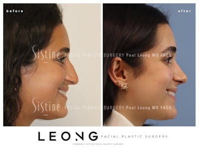 Rhinoplasty Before & After Gallery - Patient 293286 - Image 1