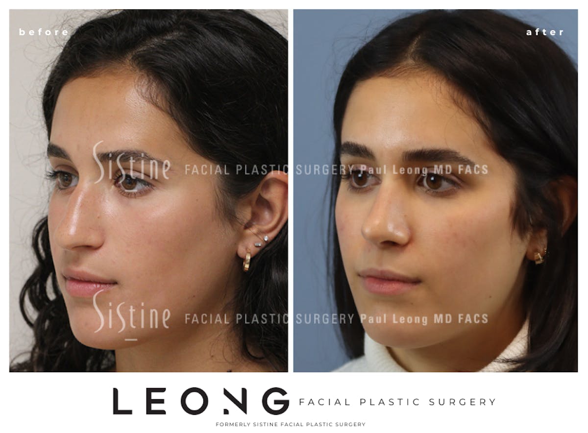 Rhinoplasty Before & After Gallery - Patient 293286 - Image 6