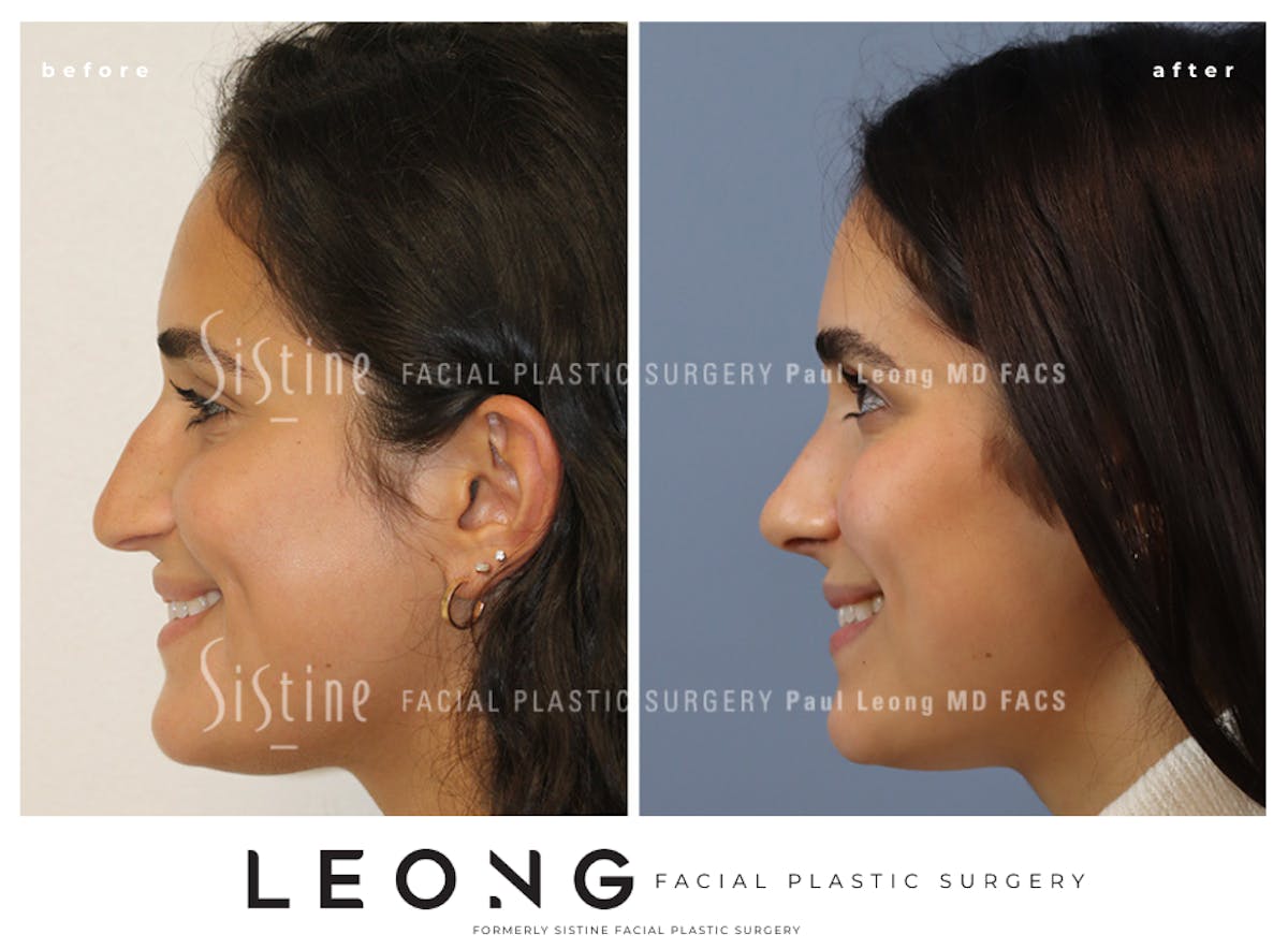 Rhinoplasty Before & After Gallery - Patient 293286 - Image 7