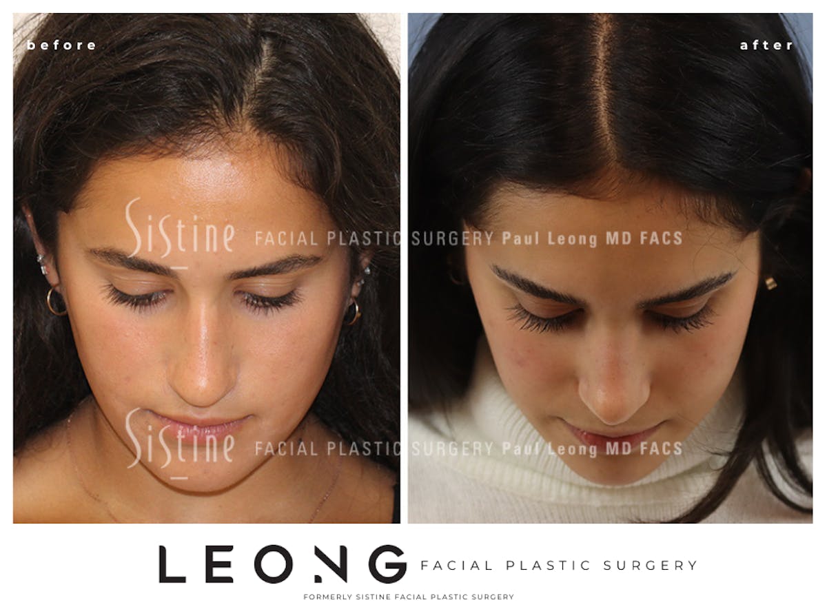 Rhinoplasty Before & After Gallery - Patient 293286 - Image 8
