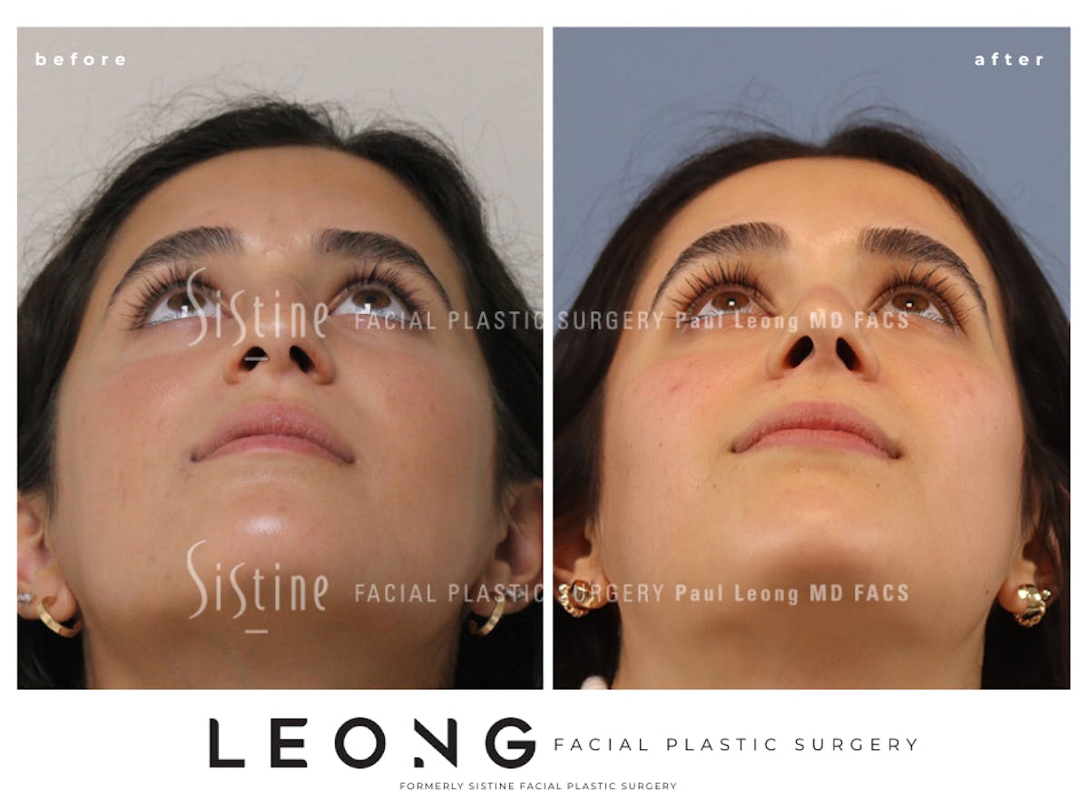 Rhinoplasty Before & After Gallery - Patient 293286 - Image 9