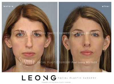 Rhinoplasty Before & After Gallery - Patient 419555 - Image 1