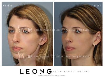 Rhinoplasty Before & After Gallery - Patient 419555 - Image 1