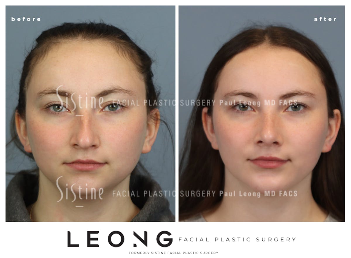 Rhinoplasty Before & After Gallery - Patient 242689 - Image 3