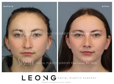 Chin Implant Before & After Gallery - Patient 116545 - Image 1