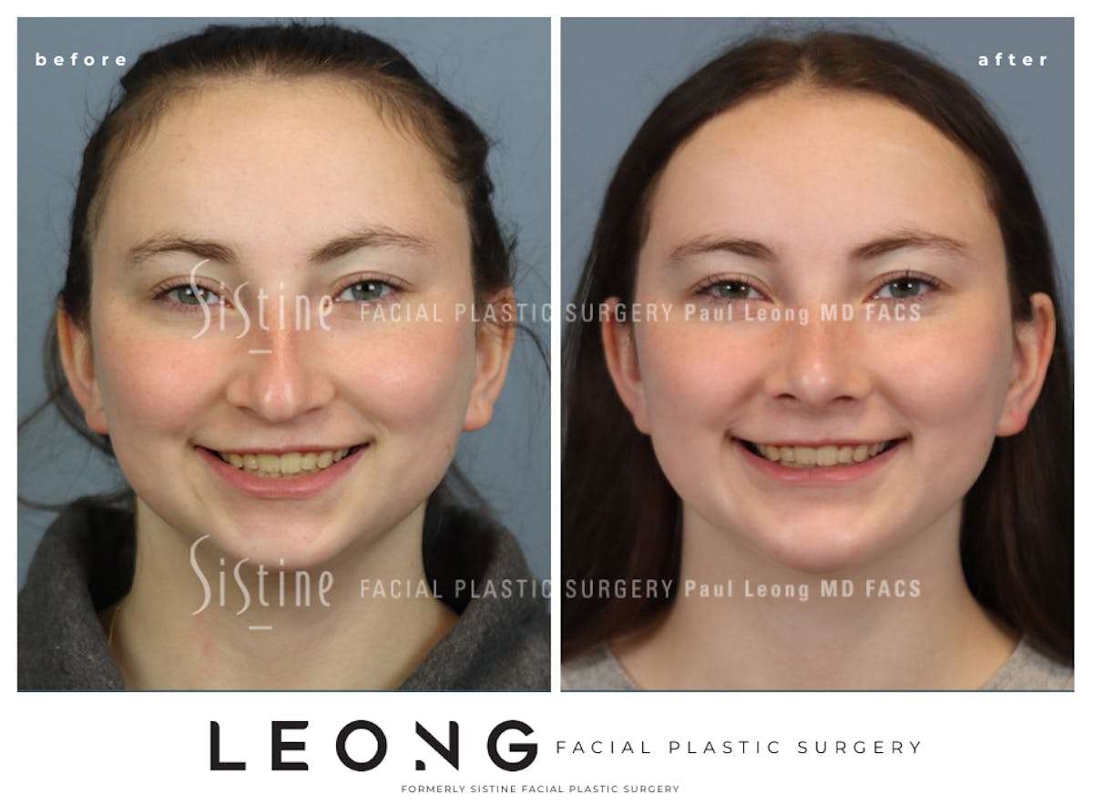 Rhinoplasty Before & After Gallery - Patient 242689 - Image 4