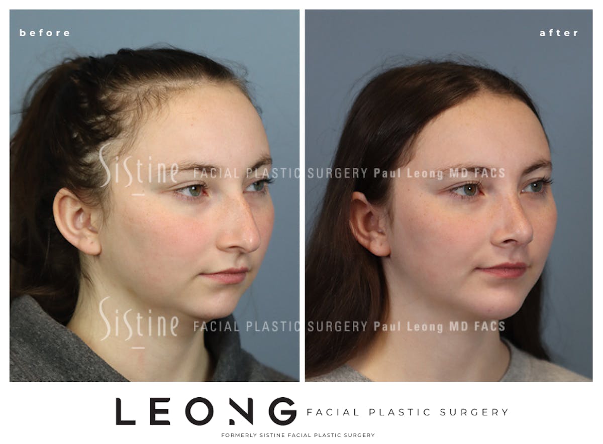 Rhinoplasty Before & After Gallery - Patient 242689 - Image 5