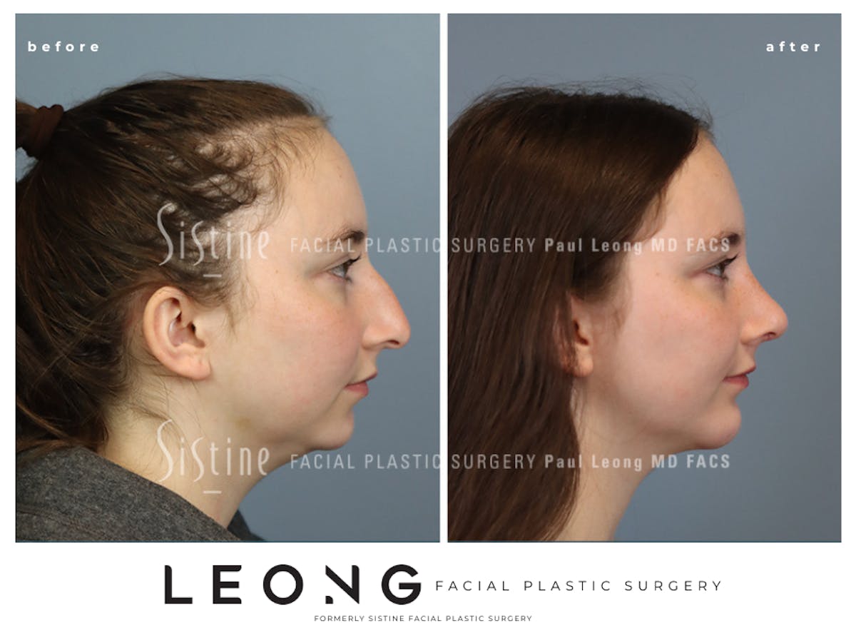 Rhinoplasty Before & After Gallery - Patient 242689 - Image 1