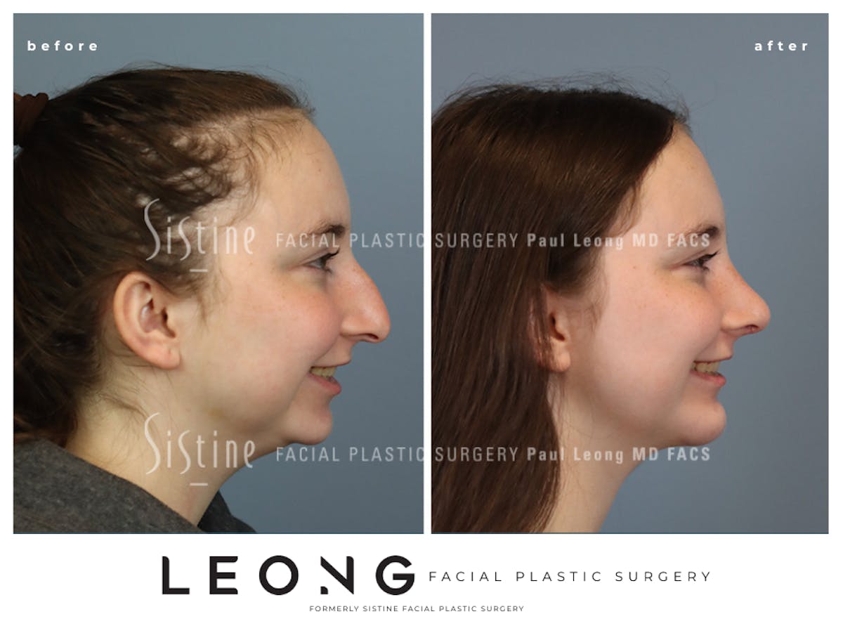 Rhinoplasty Before & After Gallery - Patient 242689 - Image 6