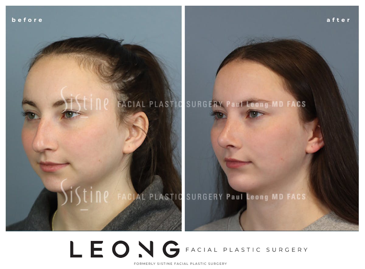 Rhinoplasty Before & After Gallery - Patient 242689 - Image 7