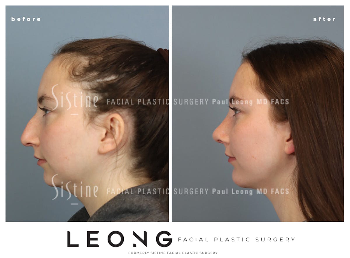 Rhinoplasty Before & After Gallery - Patient 242689 - Image 8