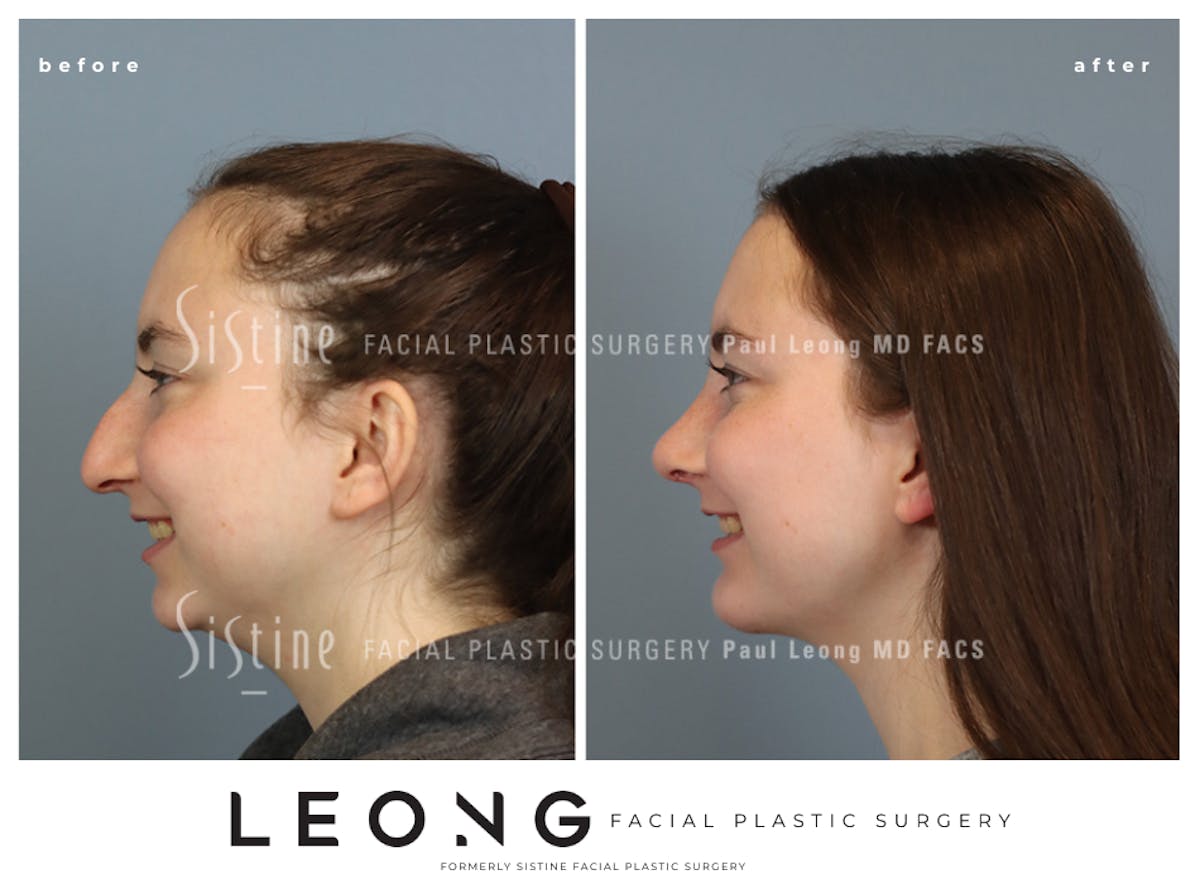 Rhinoplasty Before & After Gallery - Patient 242689 - Image 2