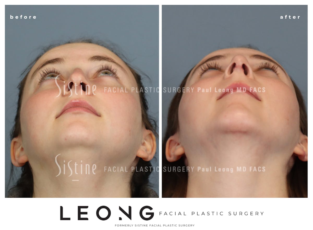 Rhinoplasty Before & After Gallery - Patient 242689 - Image 9