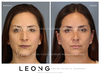 Rhinoplasty Before & After Gallery - Patient 244840 - Image 1