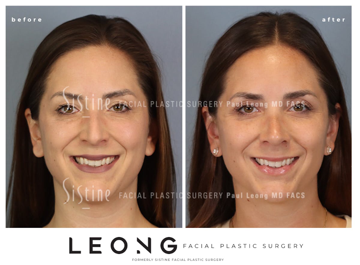 Rhinoplasty Before & After Gallery - Patient 244840 - Image 3