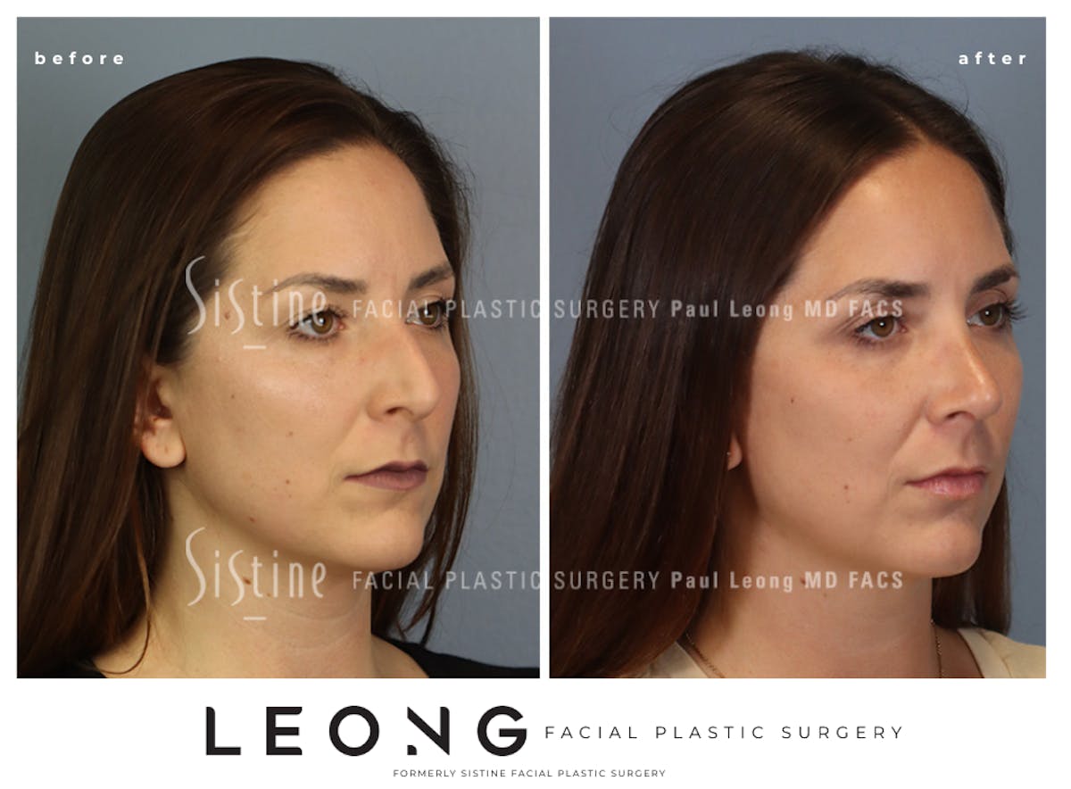 Rhinoplasty Before & After Gallery - Patient 244840 - Image 4