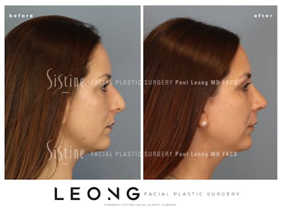 Rhinoplasty Before & After Gallery - Patient 244840 - Image 1