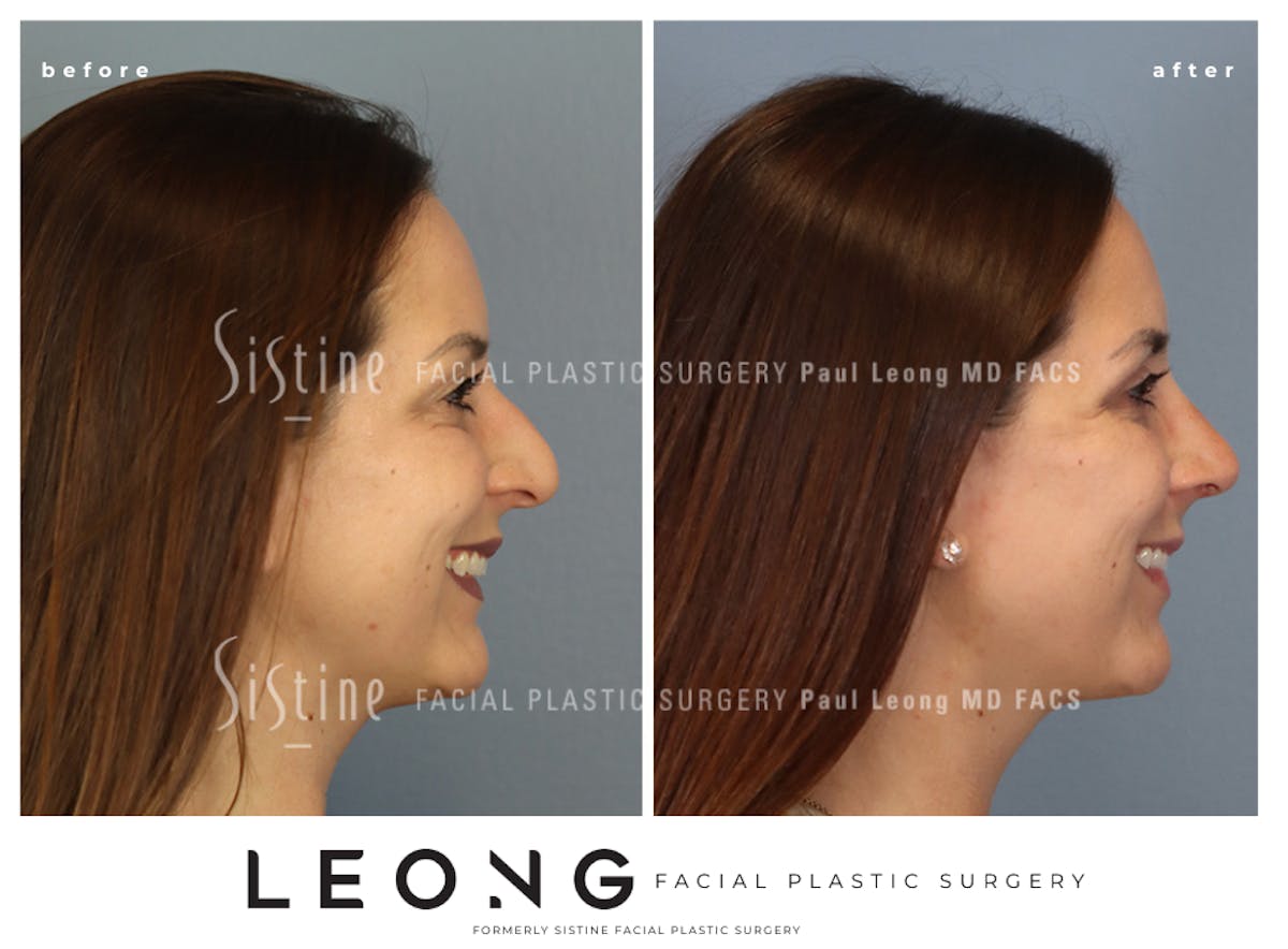 Rhinoplasty Before & After Gallery - Patient 244840 - Image 5