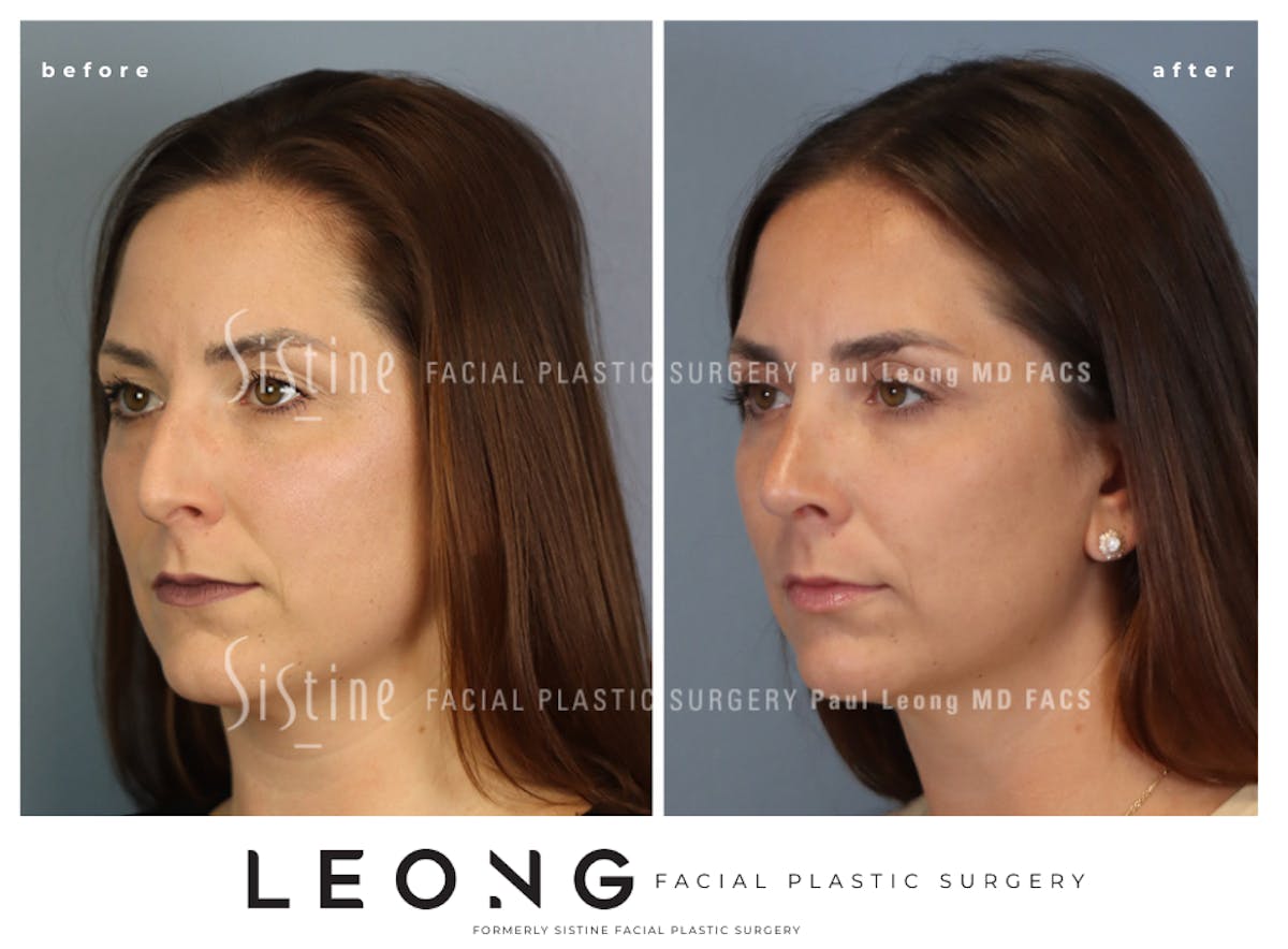 Rhinoplasty Before & After Gallery - Patient 244840 - Image 6