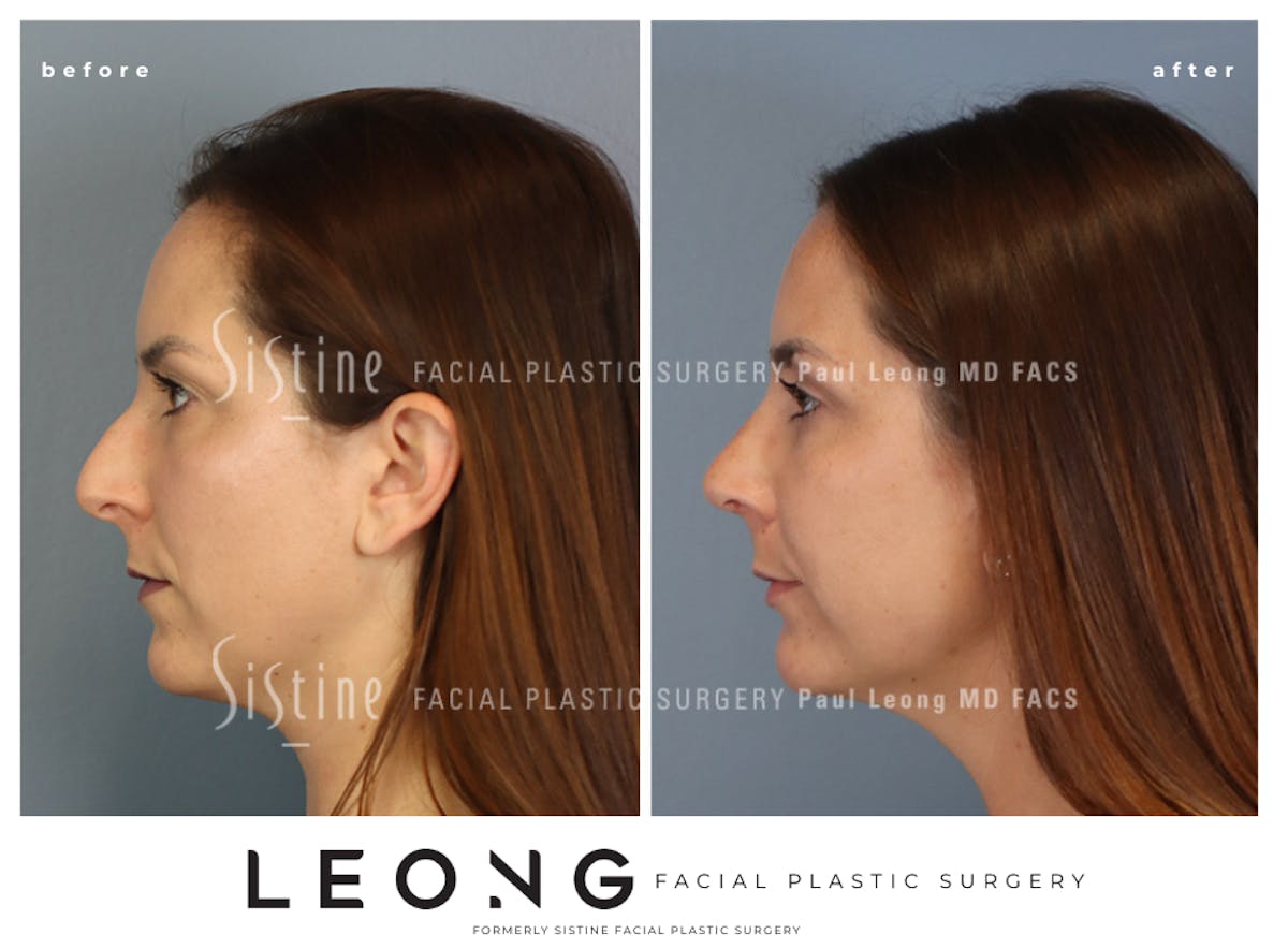 Rhinoplasty Before & After Gallery - Patient 244840 - Image 7