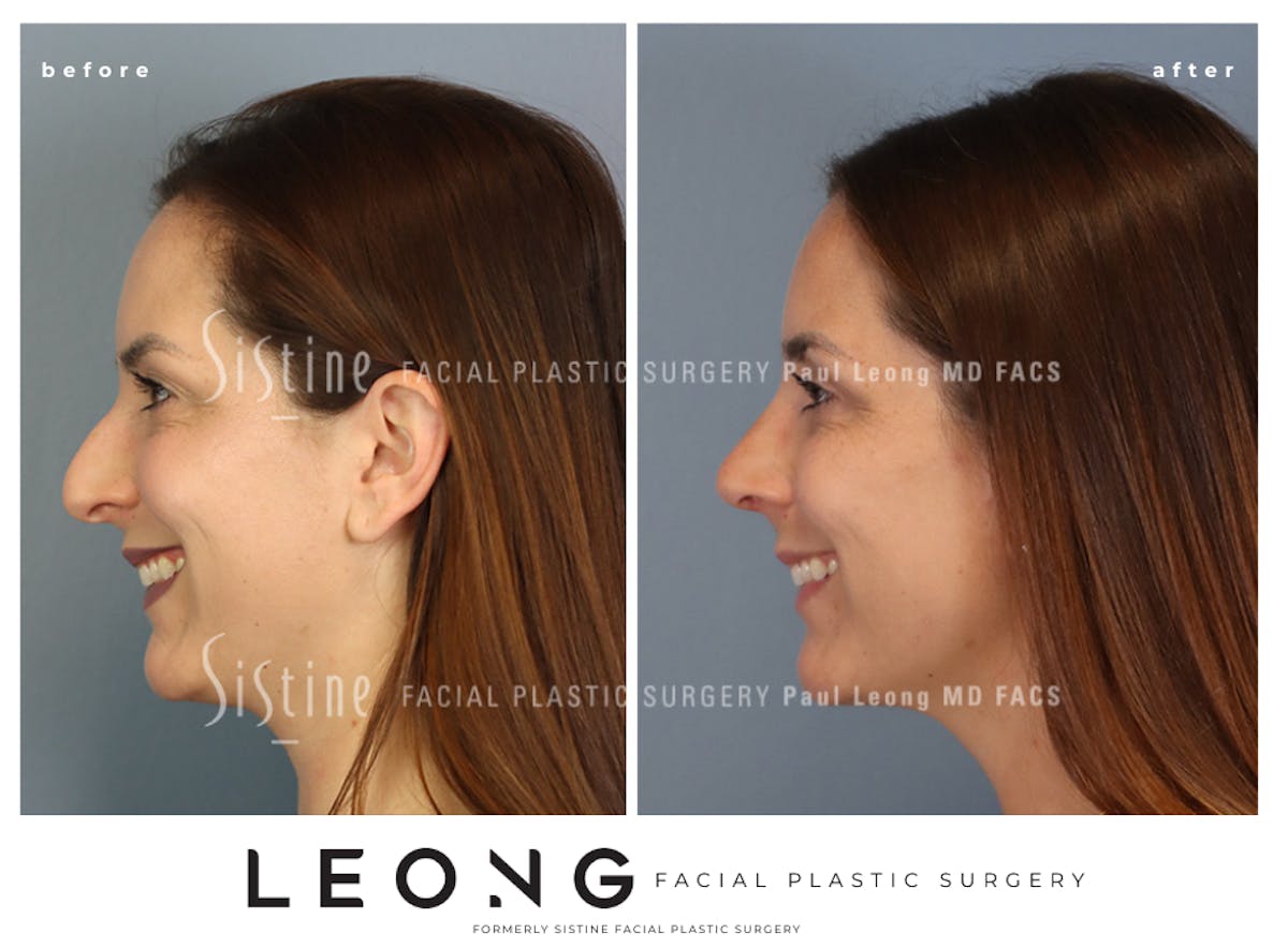 Rhinoplasty Before & After Gallery - Patient 244840 - Image 8