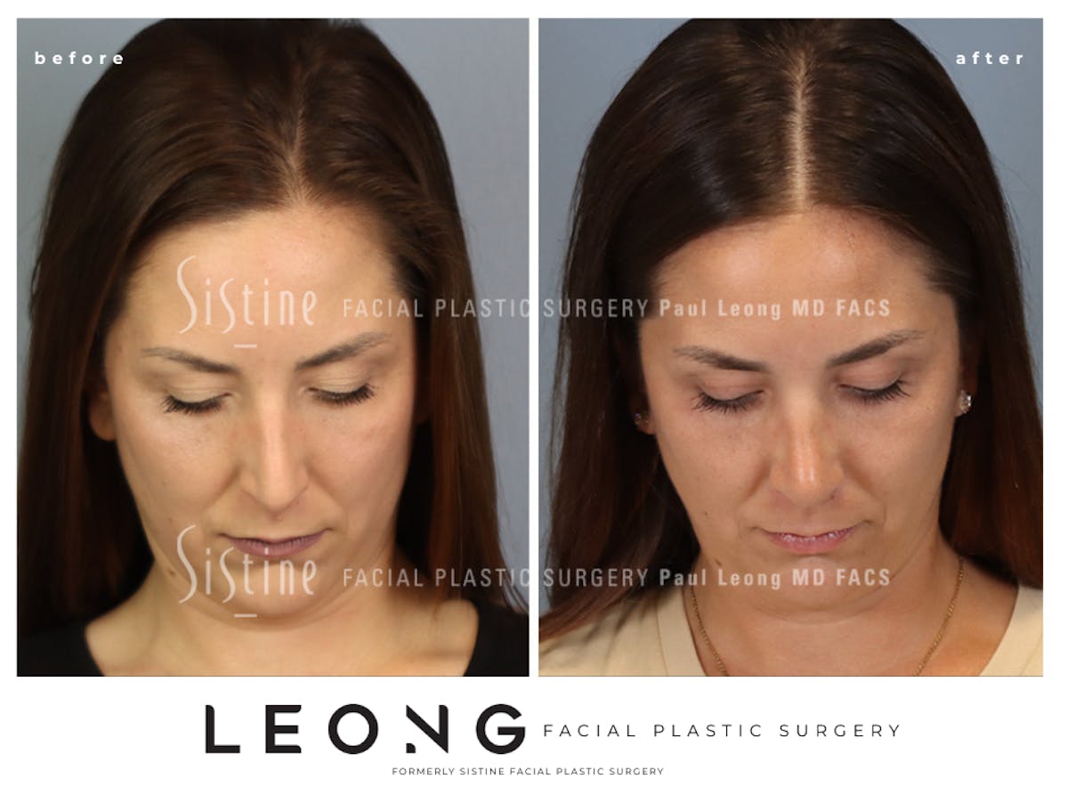Rhinoplasty Before & After Gallery - Patient 244840 - Image 9