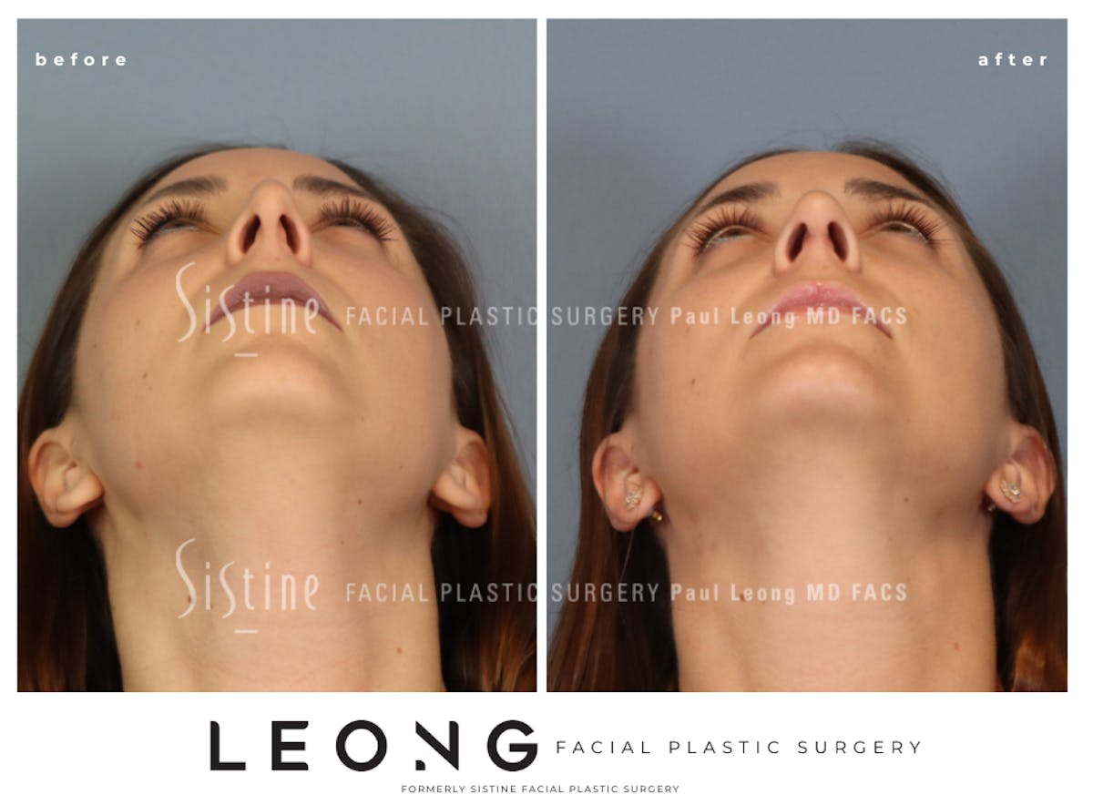 Rhinoplasty Before & After Gallery - Patient 244840 - Image 10