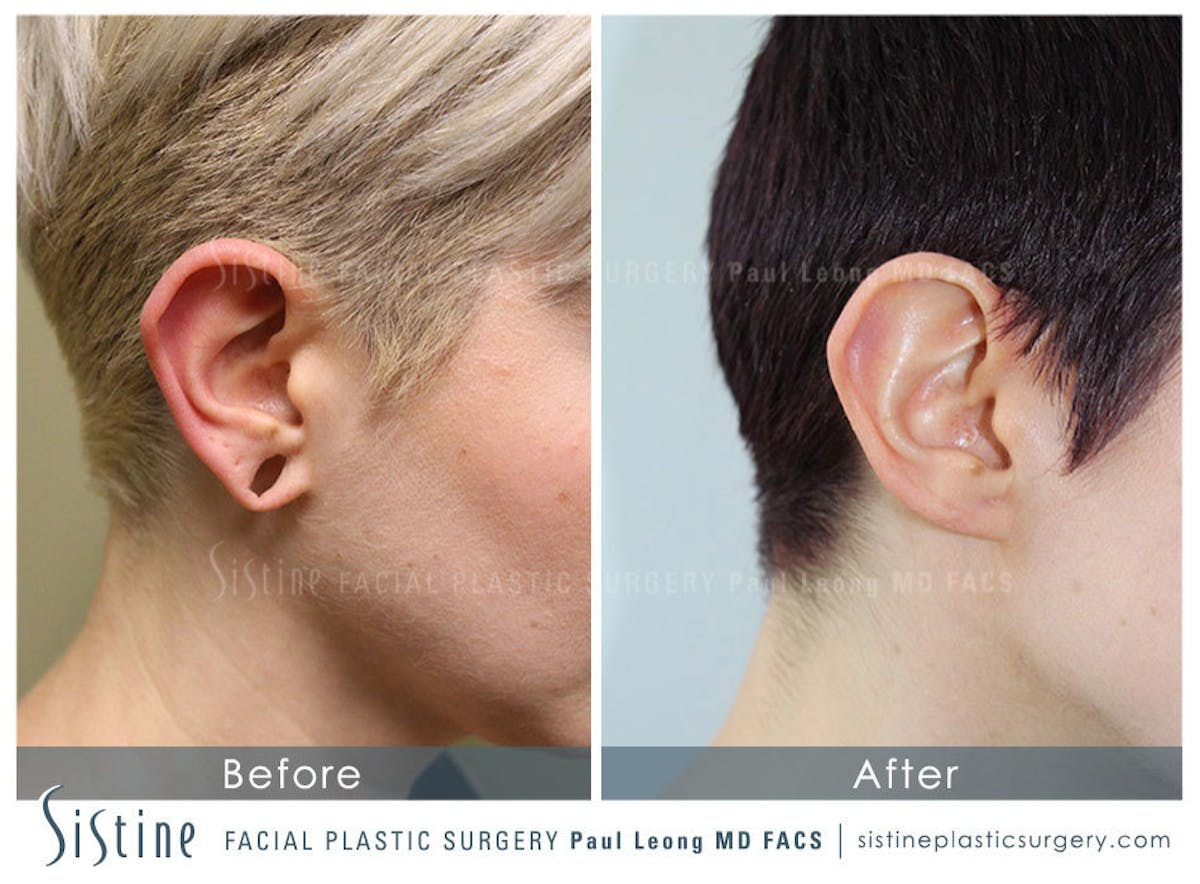 Earlobe Repair Before & After Gallery - Patient 225727 - Image 1