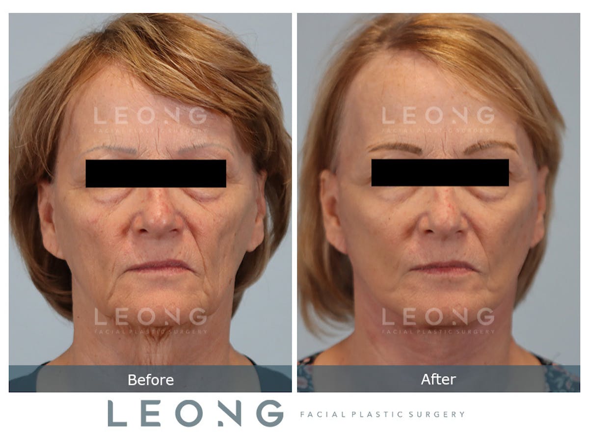 Facelift Before & After Gallery - Patient 205358 - Image 1