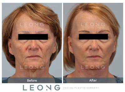 Facelift Before & After Gallery - Patient 205358 - Image 1
