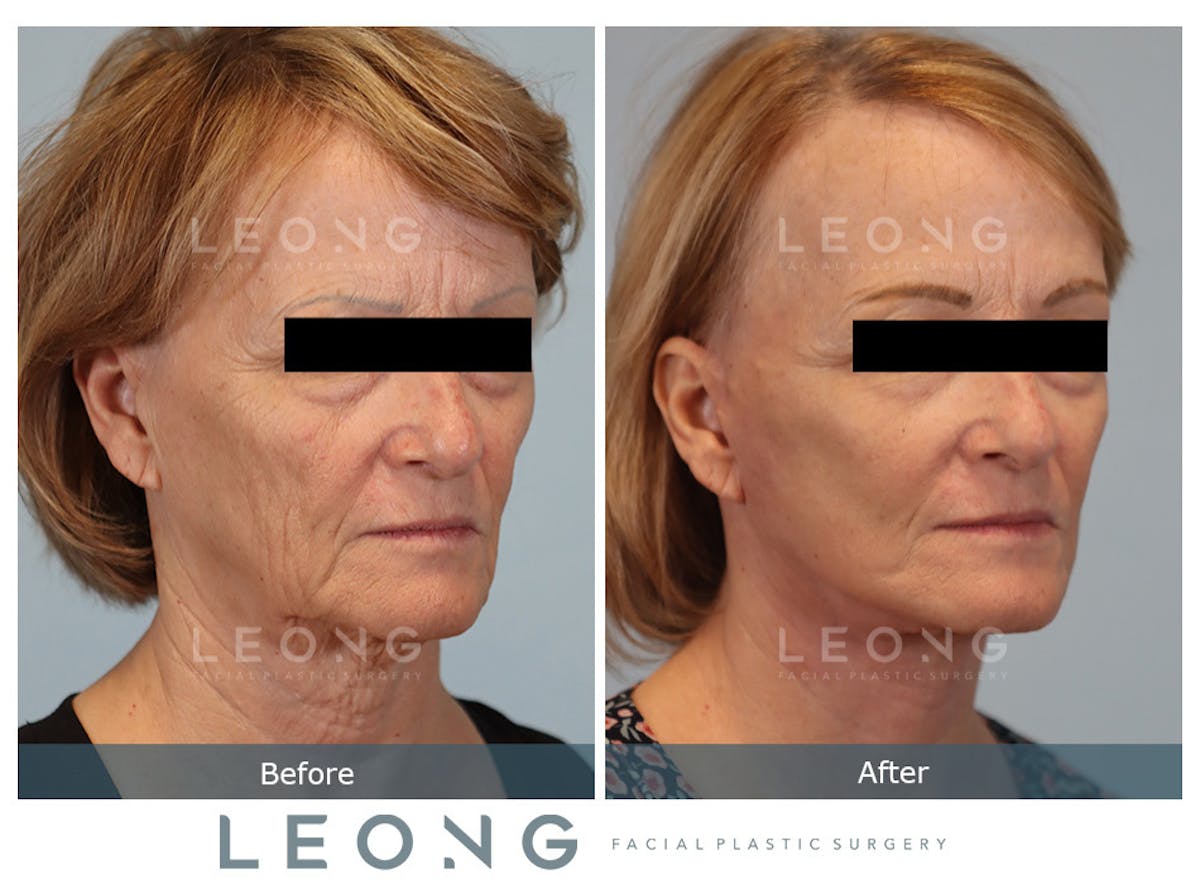 Facelift Before & After Gallery - Patient 205358 - Image 2