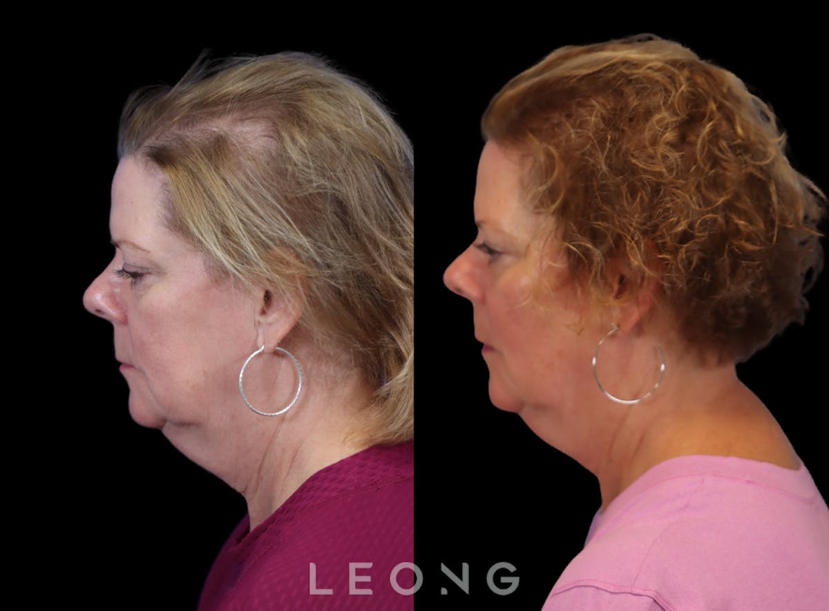 Hair Transplant Before & After Gallery - Patient 179837 - Image 5