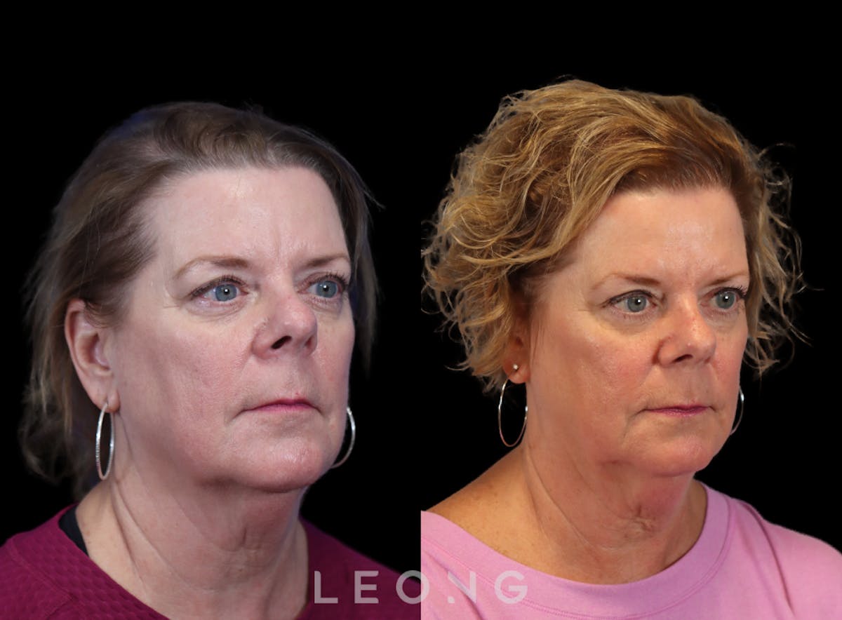 Hair Transplant Before & After Gallery - Patient 179837 - Image 2