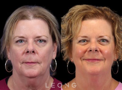 Hair Transplant Before & After Gallery - Patient 179837 - Image 1