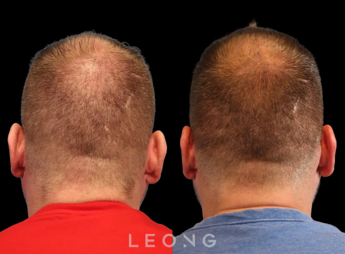 Hair Transplant Before & After Gallery - Patient 358755 - Image 5